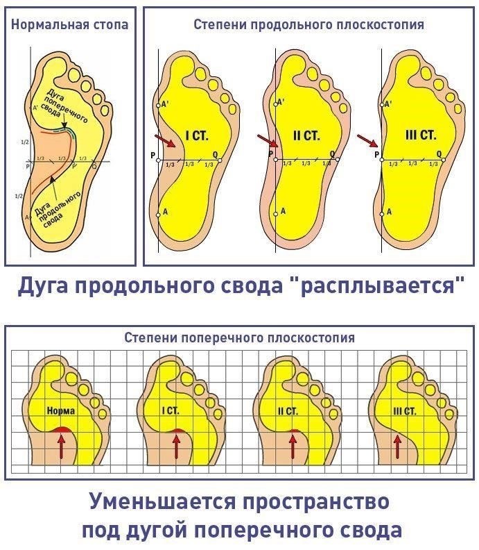 Что говорит закон о плоскостопии и военной службе?