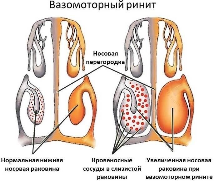 Что такое аллергический, хронический или вазомоторный ринит?
