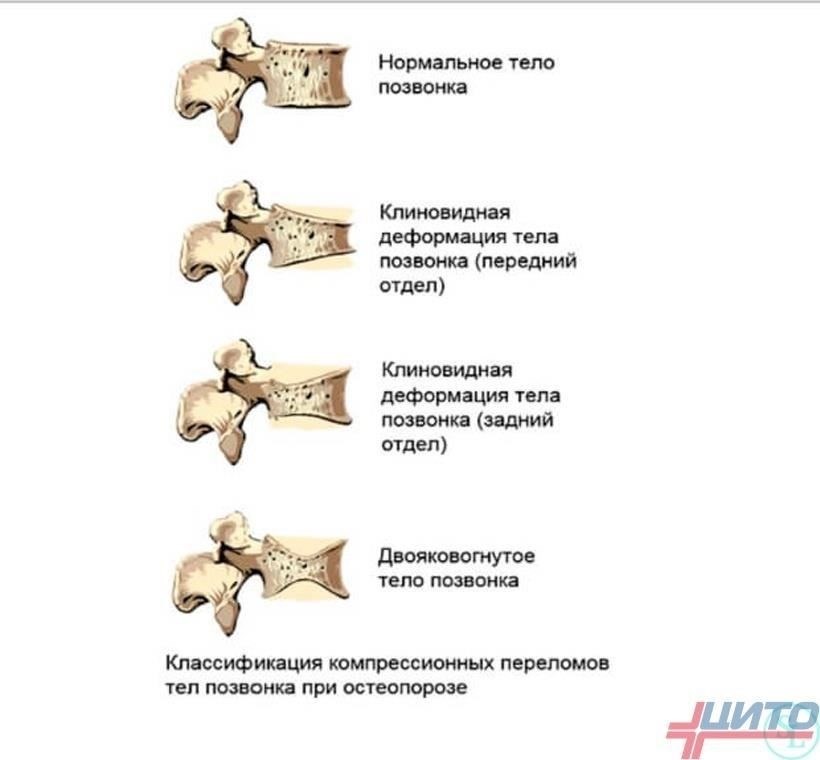 Врожденные факторы: Некоторые деформации наблюдаются с рождения из-за аномалий развития позвонков.