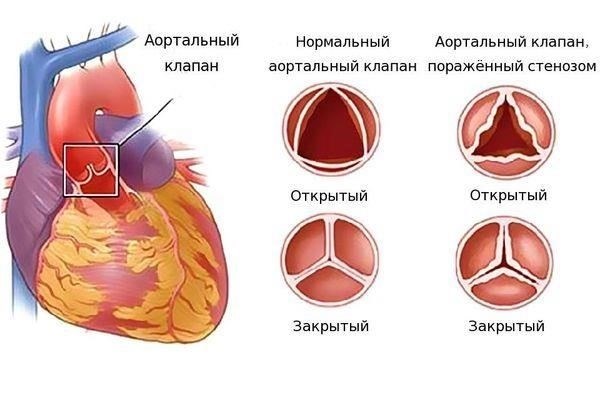 Значительные заболевания клапанов сердца, такие как стеноз или регургитация, которые препятствуют нормальному кровообращению.